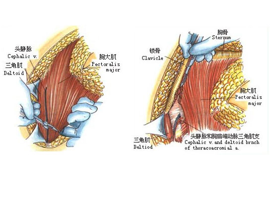 切胸手术图解图片