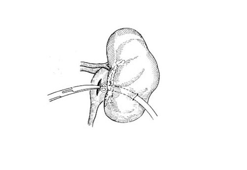 肾造瘘管示意图图片