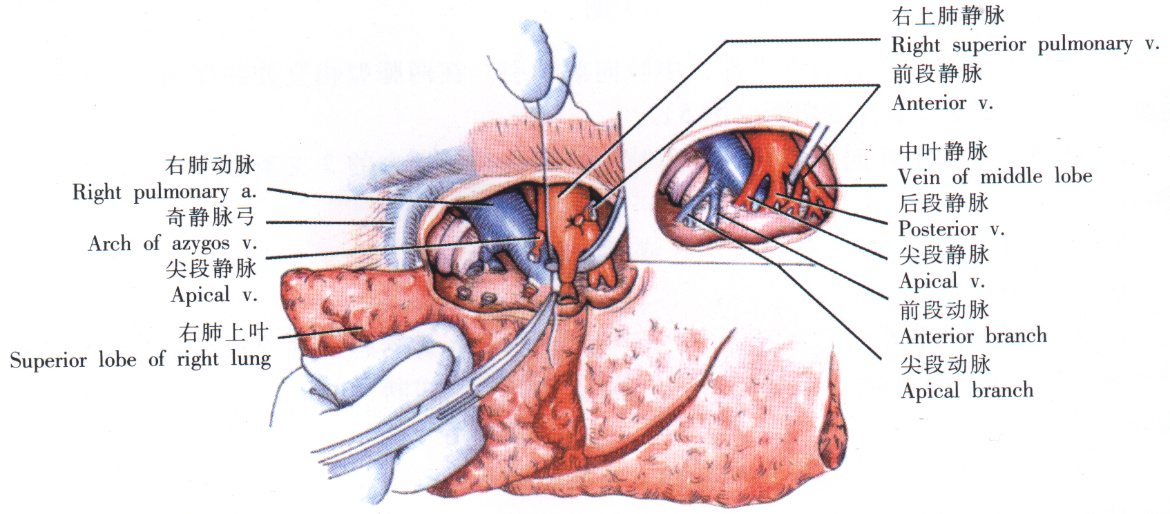 肺楔形切除术示意图图片
