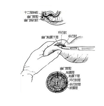 幽门环肌切开术示意图图片