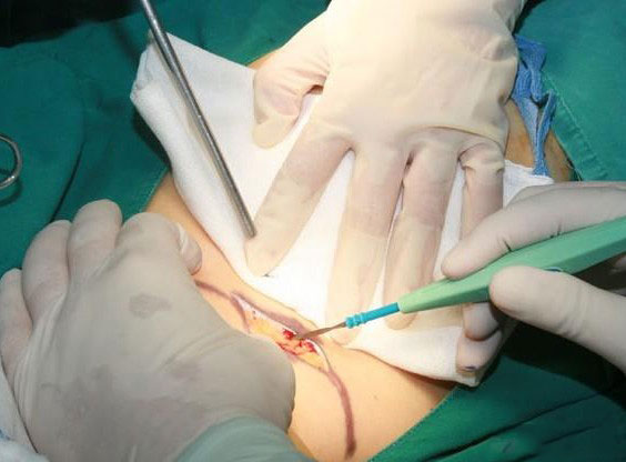乳腺增生微创手术图片图片