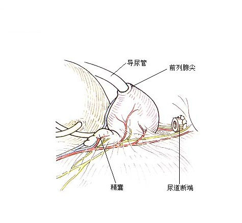 根治性前列腺切除术过程手术图解