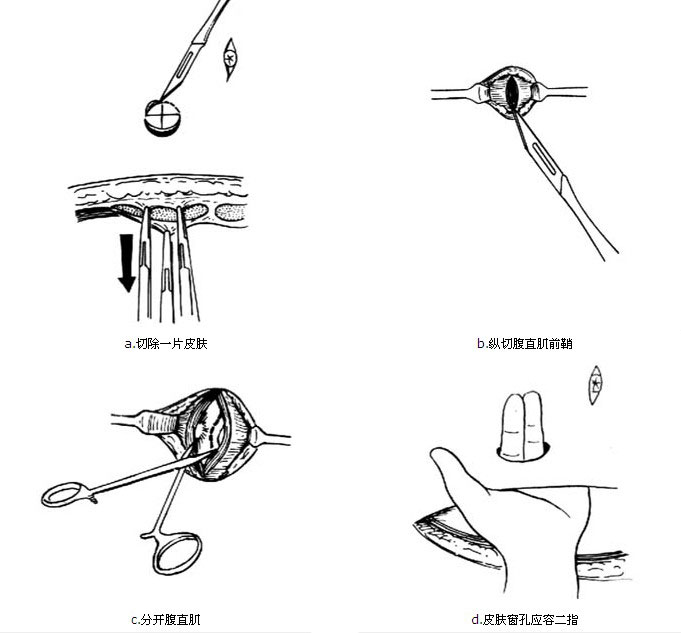 回肠代膀胱术示意图图片