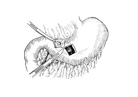 胃穿孔缝合方法图解图片