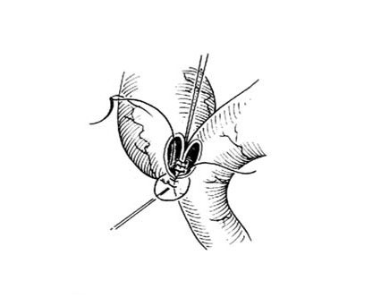 胆总管空肠吻合术图解图片