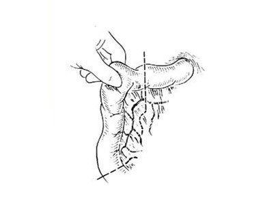胆总管空肠吻合术图解图片