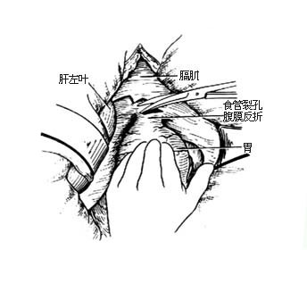 分離食管下端 切開賁門處腹膜反折.