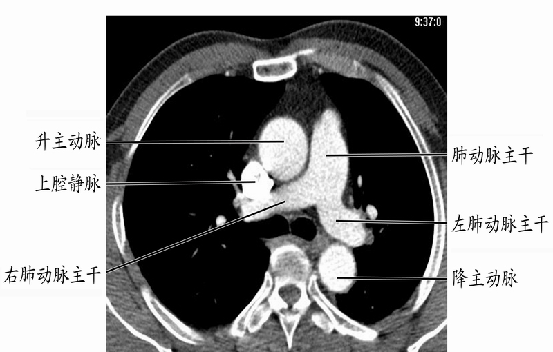 胸锁关节ct扫描范围图片