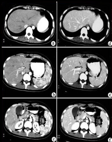 肝脏分叶分段ct图像图片