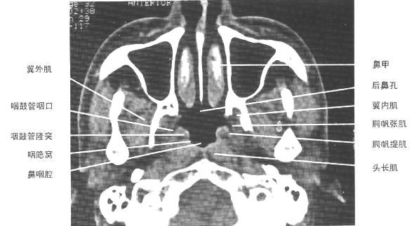 副鼻窦ct解剖结构图图片