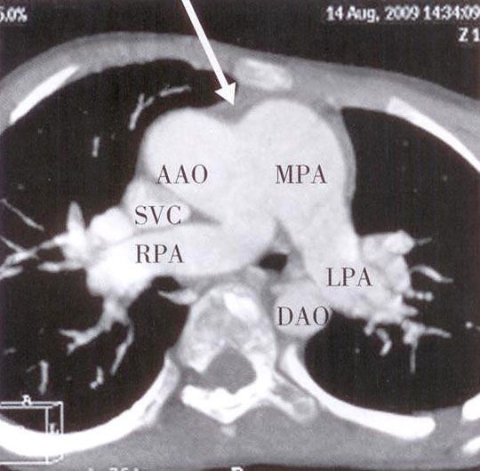 主动脉肺动脉间隔缺损图片