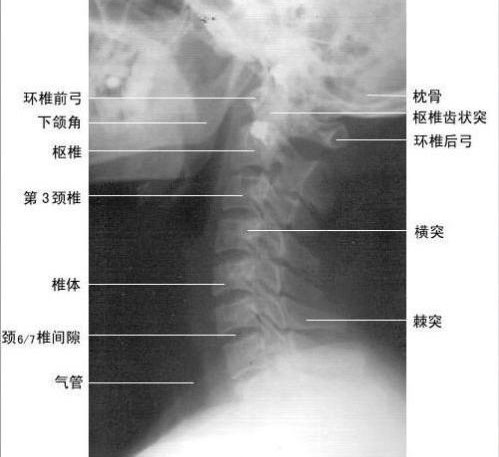 颈椎矢状面解剖图图片