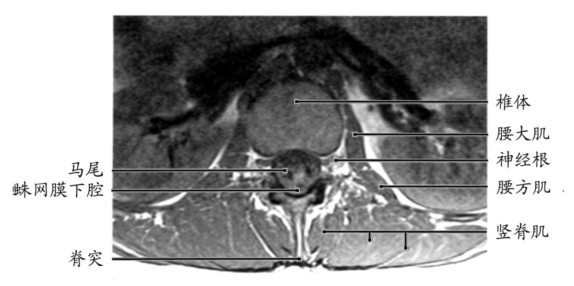 腰椎ct断层解剖图谱图片